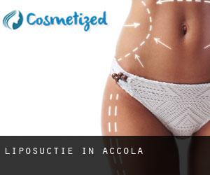 Liposuctie in Accola