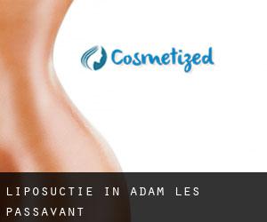 Liposuctie in Adam-lès-Passavant