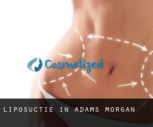 Liposuctie in Adams Morgan