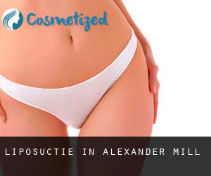 Liposuctie in Alexander Mill
