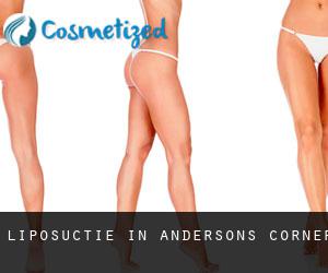 Liposuctie in Andersons Corner