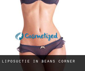 Liposuctie in Beans Corner