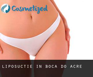 Liposuctie in Boca do Acre
