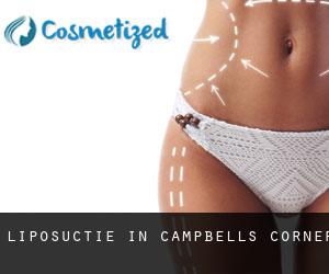 Liposuctie in Campbells Corner