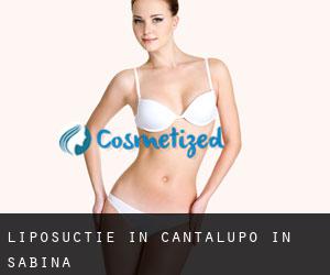 Liposuctie in Cantalupo in Sabina