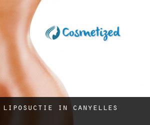 Liposuctie in Canyelles