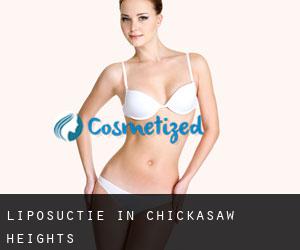 Liposuctie in Chickasaw Heights