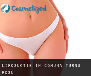 Liposuctie in Comuna Turnu Roşu