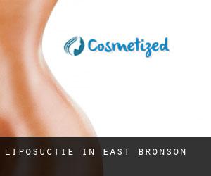 Liposuctie in East Bronson