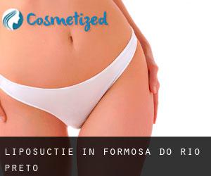 Liposuctie in Formosa do Rio Preto