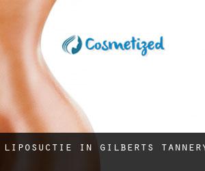 Liposuctie in Gilberts Tannery