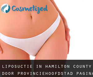 Liposuctie in Hamilton County door provinciehoofdstad - pagina 5