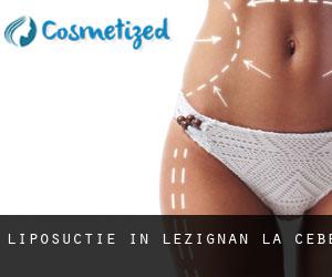 Liposuctie in Lézignan-la-Cèbe