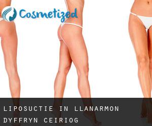 Liposuctie in Llanarmon Dyffryn-Ceiriog