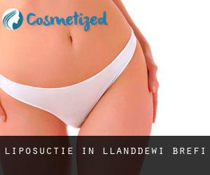Liposuctie in Llanddewi-Brefi