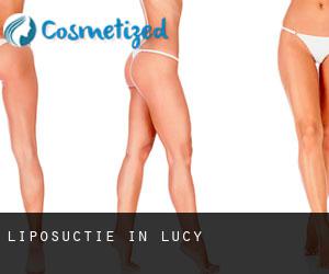 Liposuctie in Lucy