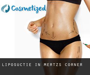 Liposuctie in Mertz's Corner