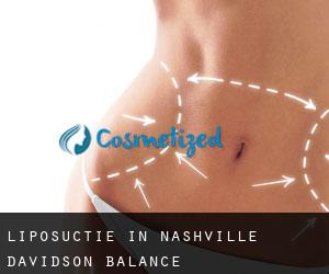 Liposuctie in Nashville-Davidson (balance)