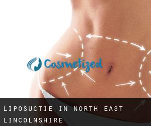 Liposuctie in North East Lincolnshire