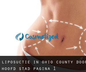 Liposuctie in Ohio County door hoofd stad - pagina 1