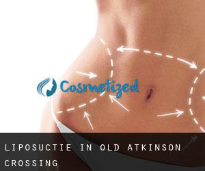 Liposuctie in Old Atkinson Crossing