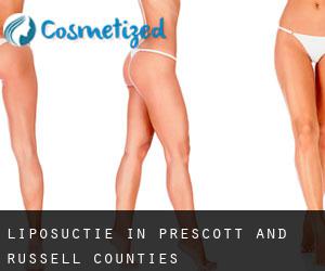 Liposuctie in Prescott and Russell Counties