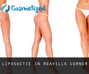 Liposuctie in Reavills Corner