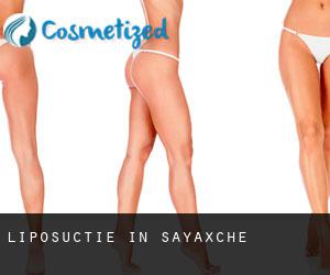 Liposuctie in Sayaxché