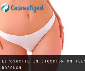Liposuctie in Stockton-on-Tees (Borough)