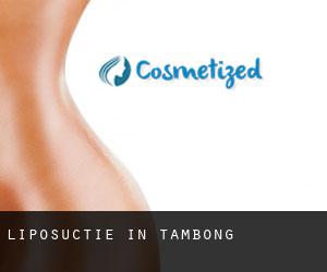 Liposuctie in Tambong