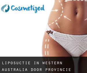 Liposuctie in Western Australia door Provincie - pagina 3