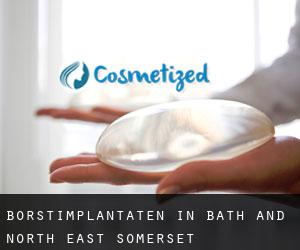 Borstimplantaten in Bath and North East Somerset