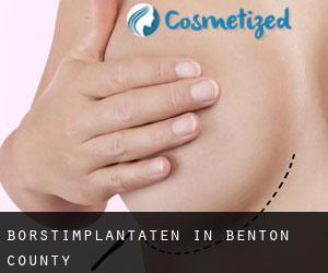 Borstimplantaten in Benton County