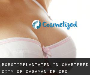 Borstimplantaten in Chartered City of Cagayan de Oro