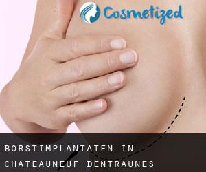 Borstimplantaten in Châteauneuf-d'Entraunes