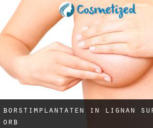 Borstimplantaten in Lignan-sur-Orb