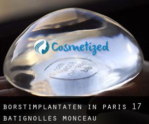 Borstimplantaten in Paris 17 Batignolles-Monceau