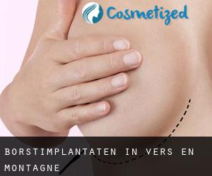 Borstimplantaten in Vers-en-Montagne