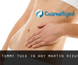 Tummy Tuck in Any-Martin-Rieux