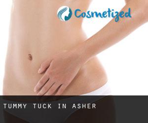Tummy Tuck in Asher