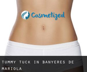 Tummy Tuck in Banyeres de Mariola
