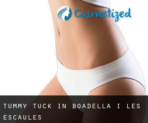 Tummy Tuck in Boadella i les Escaules