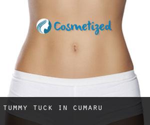 Tummy Tuck in Cumaru