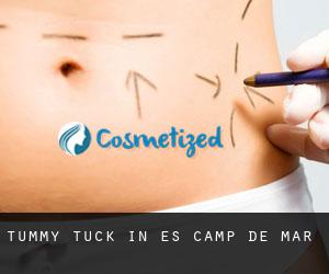 Tummy Tuck in es Camp de Mar