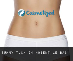 Tummy Tuck in Nogent-le-Bas