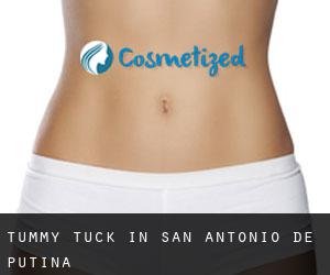 Tummy Tuck in San Antonio De Putina
